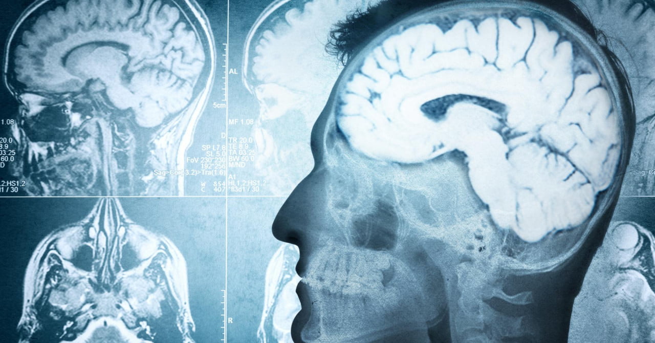 ČUDESNO OTKRIĆE: Otkrivene misteriozne promjene u mozgu osoba koje pate od migrene