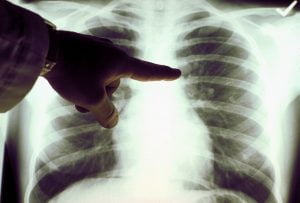 RTG-pluća