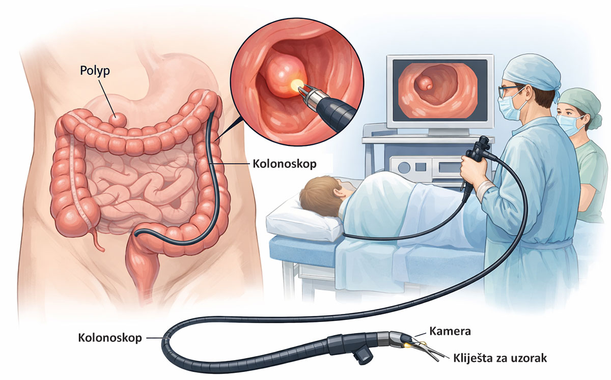 Ilustrativna slika kolonoskopije